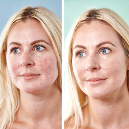 Sorted Skin 5 in 1 Anti-Redness Day Cream SPF 50 - 30ml.