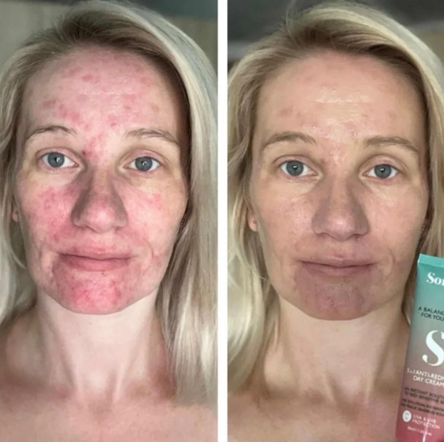 Sorted Skin 5 in 1 Anti-Redness Day Cream SPF 50 - 30ml.